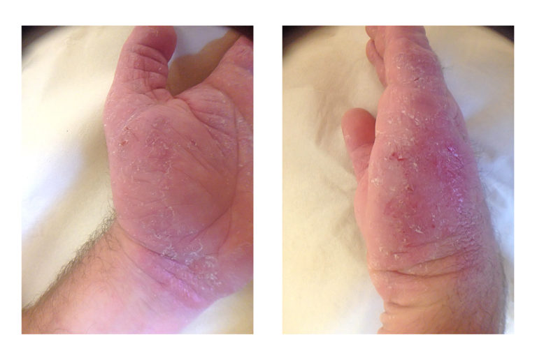 Examples of hand eczema_IMG_2854_IMG_2858.jpg