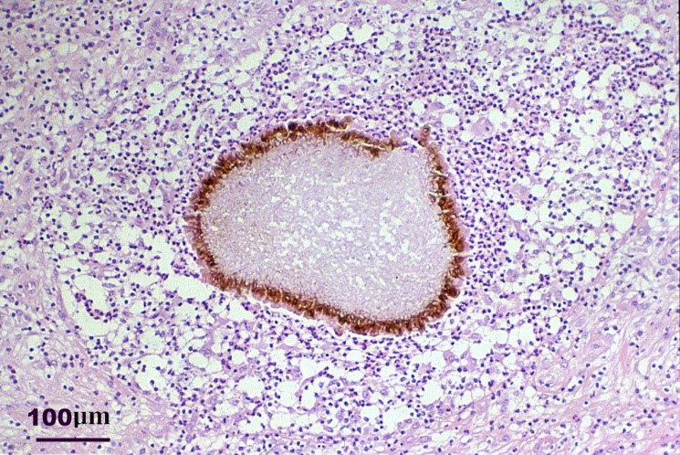Madurella mycetomatis (brown) in tissue (purple)