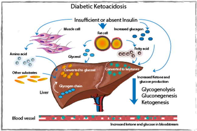 The process of diabetic ketoacidosis diagram
