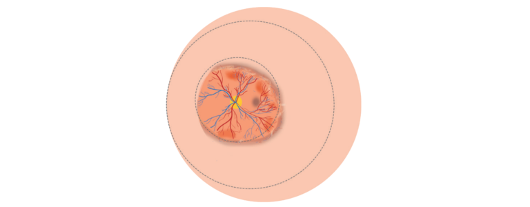 Illustration of retinal image showing Zones I & II, stages 2 & 3 ROP with plus disease. 