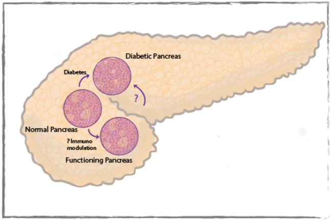 The effect of diabetes on the pancreas showing a pancreas with pink patches containing cells.