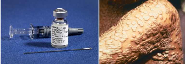 Left, photo of a bottle with label reading smallpox vaccine and injection needle. Right, photo of a small pox rash on a child's arm