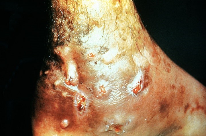 The ankle of a patient suffering from severe mycetoma