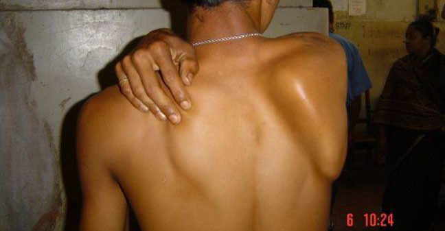 Winging of the scapula