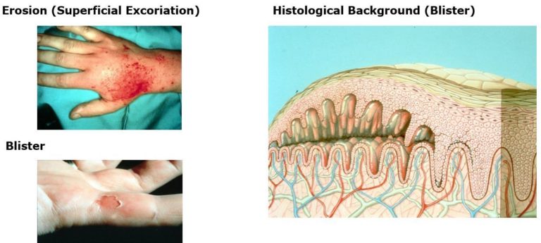 Image showing when regeneration of a wound occurs: after erosion and blistering.