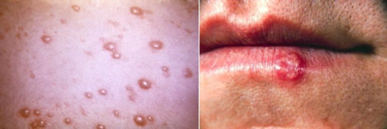 Left, image of chickenpox blisters - raised bumps. Right, image of cold sore on lip