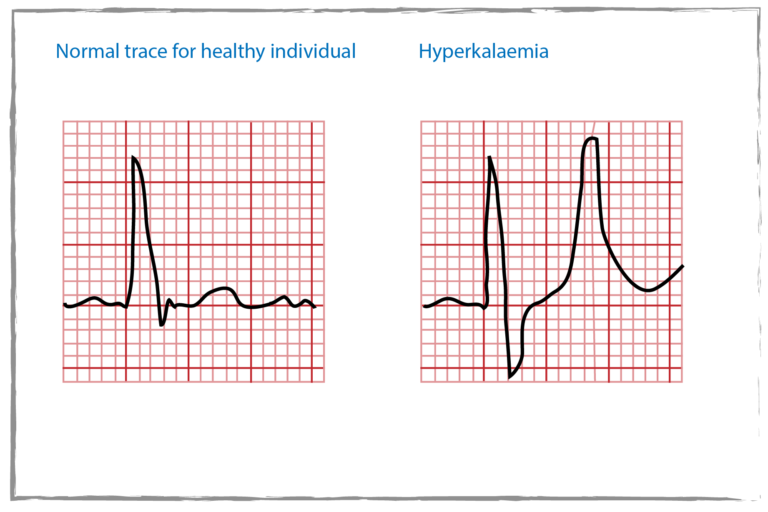 Hyperkalaemia chart showing a normal trace on the left with regular cardiac rhythm and Hyperkalaemia on the right with an abnormal rhythm.