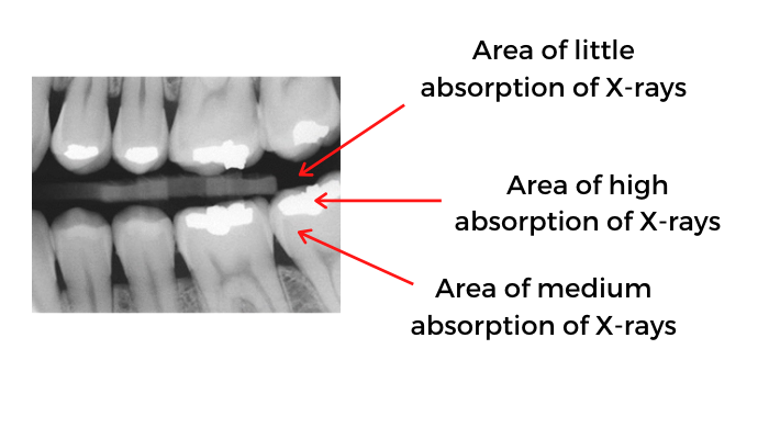 Dental x-ray showing that darkest spaces are the area of little absorption of x-rays, medium/grey areas are areas of medium absorption of x-rays, and light/white areas show the area of high absorption of x-rays