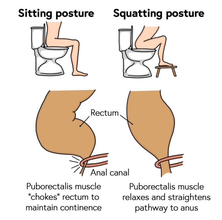 Correct posture on the toilet to relax the puborectalis muscle and straighten pathway to anus