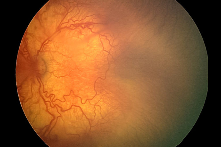Retinal photograph showing the indications of APROP as described for Lucas above