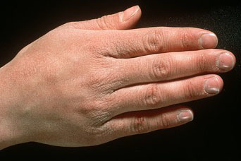 Photograph of a hand with typical manifestations of an irritant contact dermatitis.