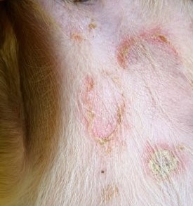 Image of a an acute flare up of atopic dermatitis and a typical staphlococcal infection with epidermal collarettes forming.