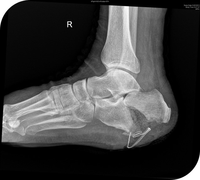 An x-ray of the wounded foot.