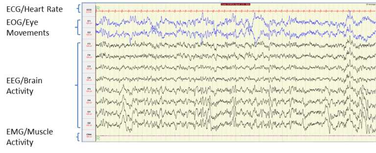 image of brain activity measurements during REM sleep