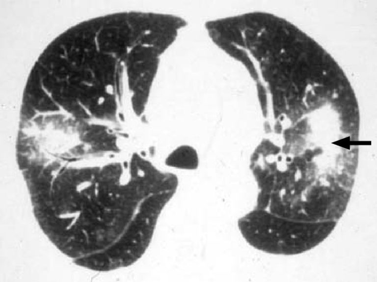 CT scan image of the chest showing both lungs. the Right hand lung has a large white section with a lighter halo surrounding it suggesting infection