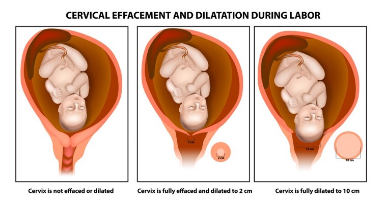 cervical effacement