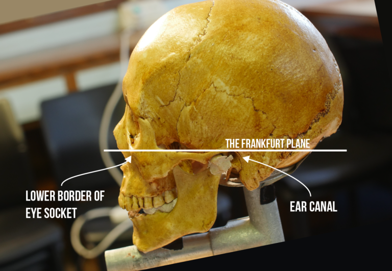 Image showing The ‘frankfurt plane’ of a skull.