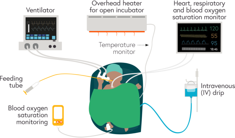 Illustration with a preterm baby in an incubator at the centre of the key pieces of equipment and monitors: Ventilator, overhead heater for open incubator and temperature monitor, heart, respiratory and blood oxygen saturation monitor, IV drip, ambient oxygen analyser and feeding tube
