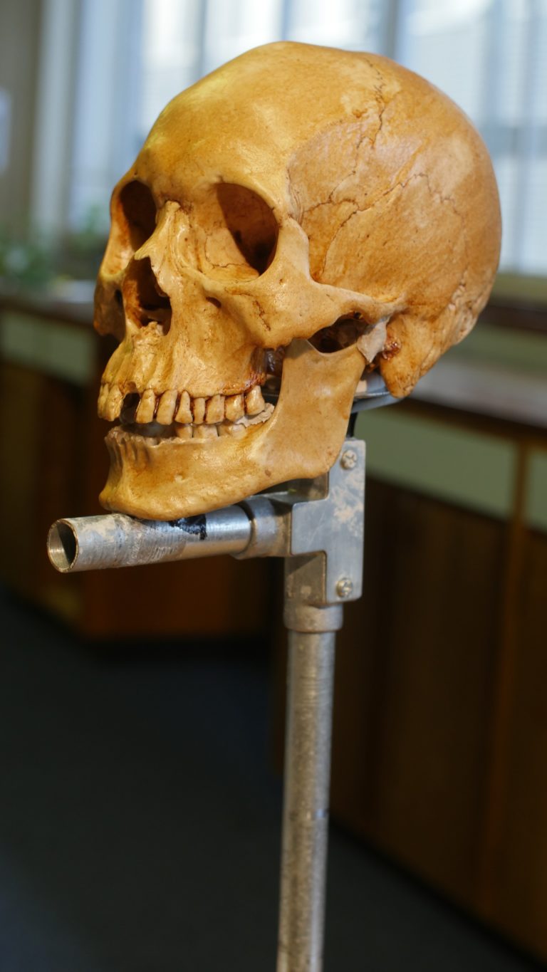 A replica of Mr. X’s skull having been placed on a stand, specially made for facial reconstructions. We can see the clay used to attach the mandible (jaw bone) to the skull.