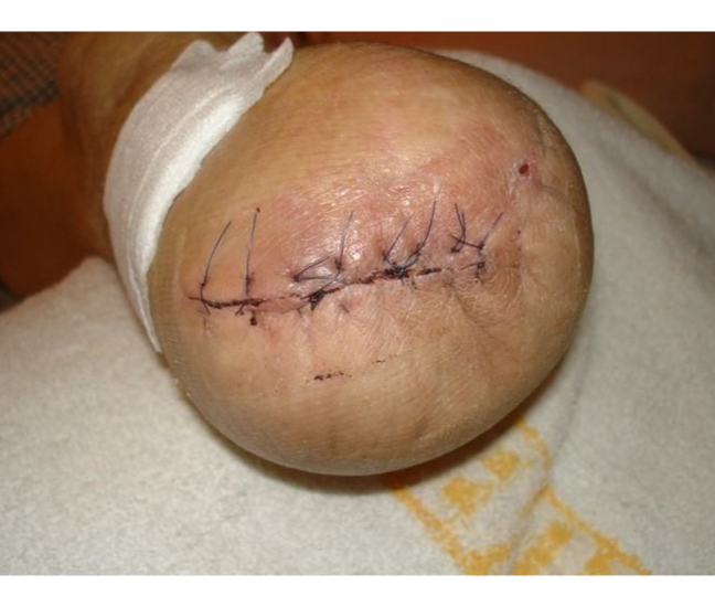 An image of the closed wound from the amputation.