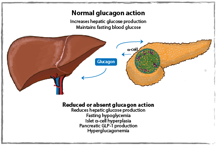 Normal glucagon action and reduced or absent glucagon action diagram showing the relationship between the pancreas, the liver and Glucagon. The caption reads: normal glucagon action increases hepatic glucose production, Maintains fasting blood glucose. Reduced or absent glucagon action reduces hepatic glucose production, fasting hypoglycemia, Islet alpha cell hyperplasia, Pancreatic GLP-1 production, Hyperglucagonemia