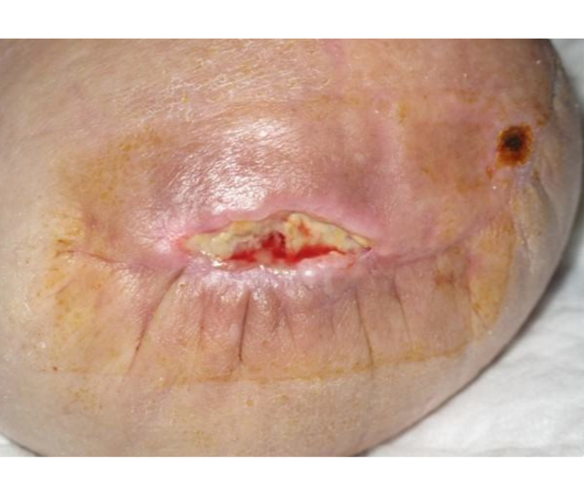 An image of the wound showing partial dehiscence after lower leg amputation.