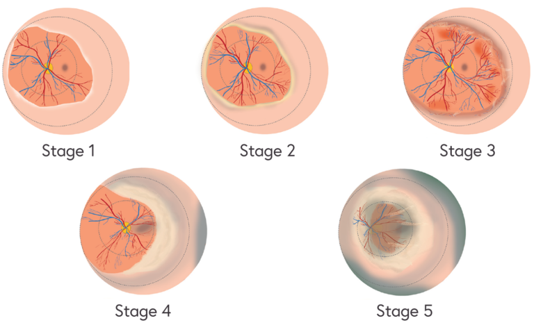 Illustration of the 5 stages of ROP as seen in the retina and described below