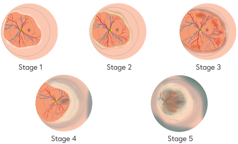 retinopathy of prematurity stage 3