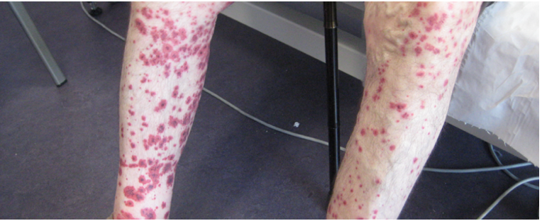 Image of legs with vasculitis-type rash