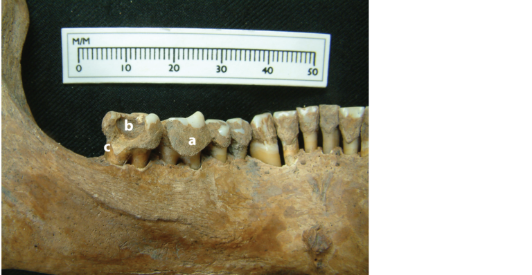 Photograph showing heavy deposits of calculus or mineralised dental plaque on the lower left teeth of Skeleton 22
