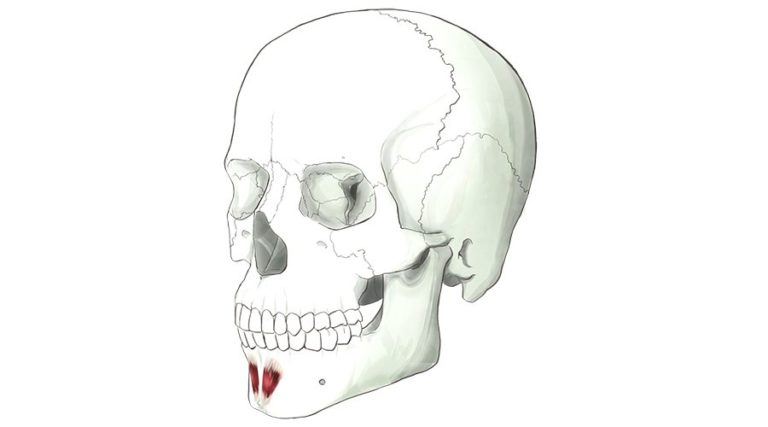 Mentalis. A concical bundle of muscle fibres that run through the fat of the chin