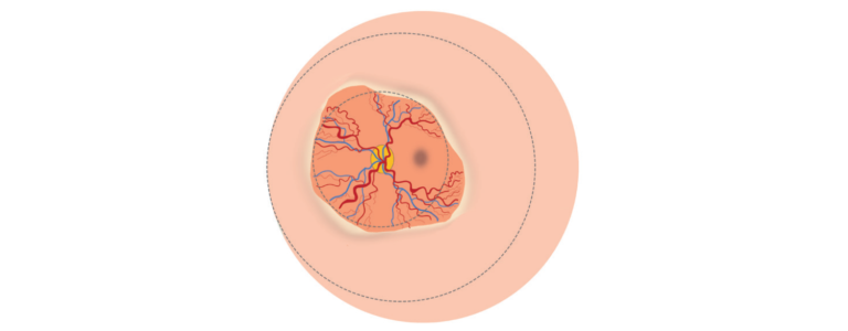 Illustration of retinal image showing Zone I, any stage ROP with plus disease