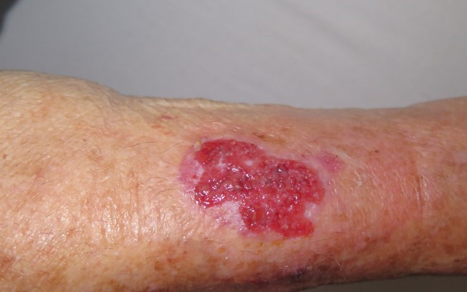 A follow up image of the wound, 3 weeks into treatment.