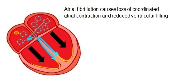 Diagram depicting Atrial fibrillation