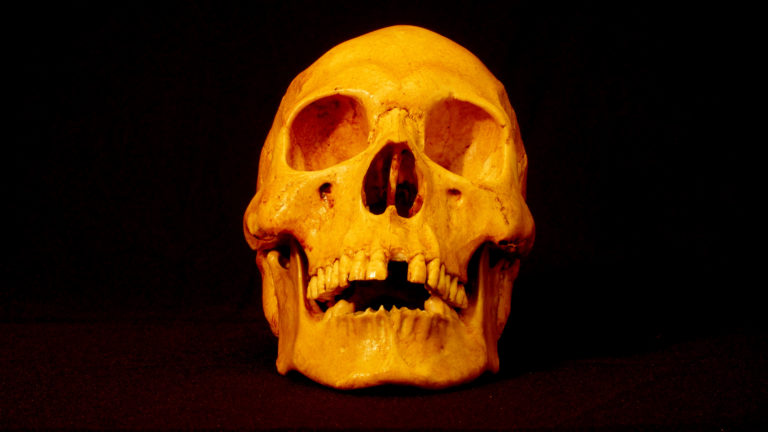 This is a replica of Mr. X’s demonstrating significant tooth loss of adult teeth