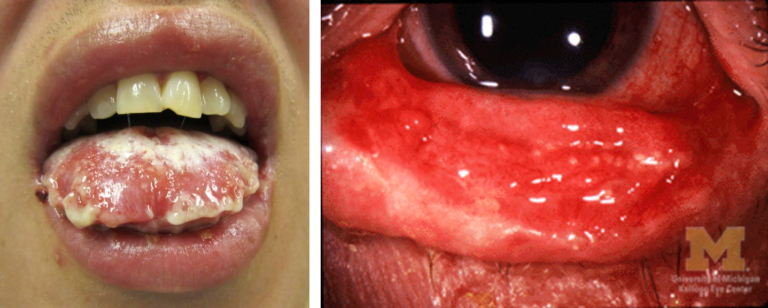 SJS/TEN symptoms. A woman with SJS/TEN symptoms on her lip and eye.