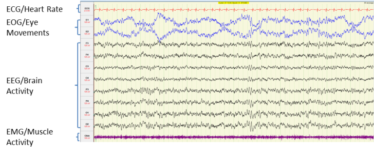 image of brain activity measurements during n1 sleep