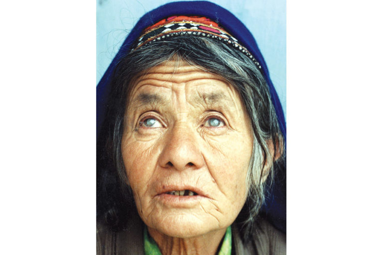 Femme âgée présentant une cataracte bilatérale