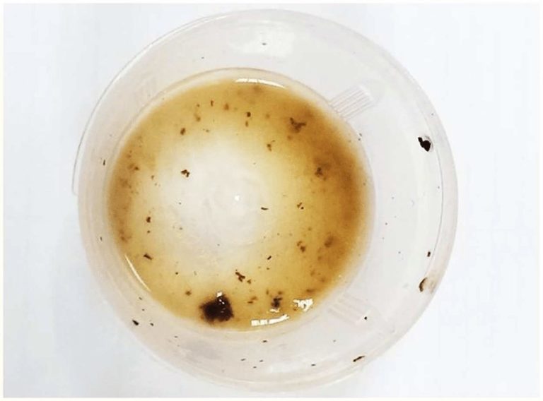 image of purulent sputum within a sample cup with fungal material visible