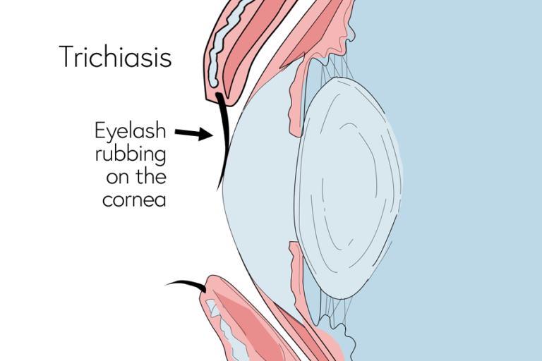 Image of trichiasis showing an eyeleash rubbing on the cornea