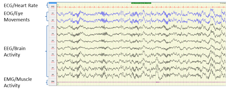 image of brain activity measurements during n2 sleep