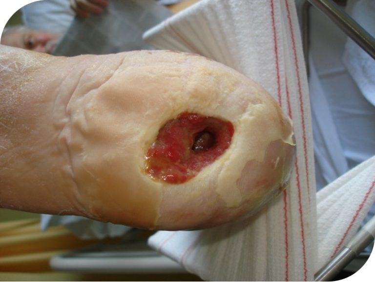 A follow up image of the foot 2 weeks after treatment with NPWT was started.