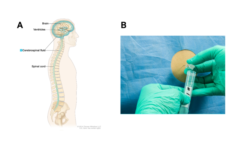 photo of person having a lumbar pucture