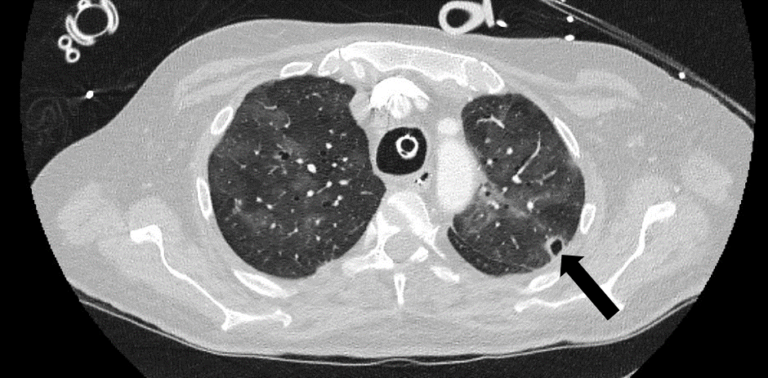 Image of an x-ray - CTPA showing ground glass opacification and a tiny new cavitary lesion in the left apex, indicated by the arrow