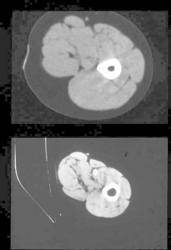 CT section of mid thigh from healthy female in her 20s and a healthy female in her 80s