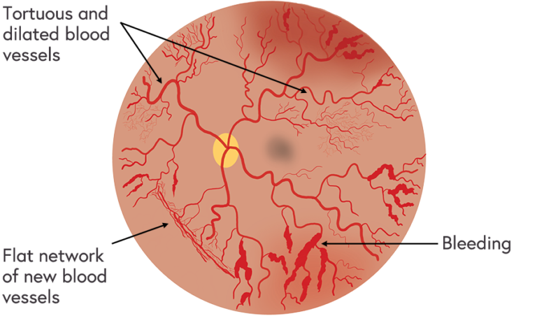 Illustration of APROP in a baby's retina showing the key signs of tortuous and dilated blood vessels, a flat network of new blood vessels and bleeding 