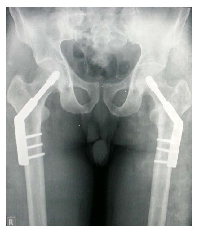 X-ray of bilateral femural neck fracture in a young mason, 6 months after his operation.