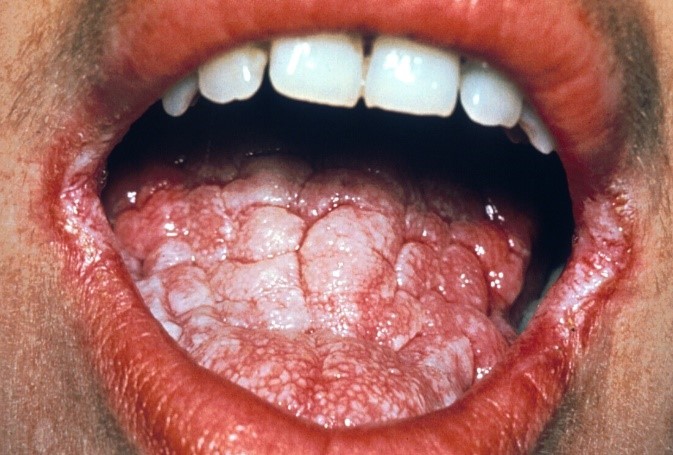 a patient suffering from chronic oral candidosis