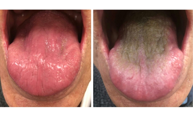 Picture of normal tongue next to one with brown growth on it