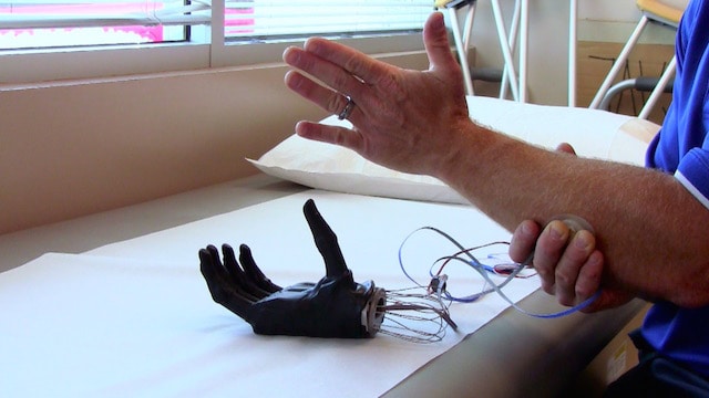 An example of 3D bioprinting: a robotic prosthetic hand